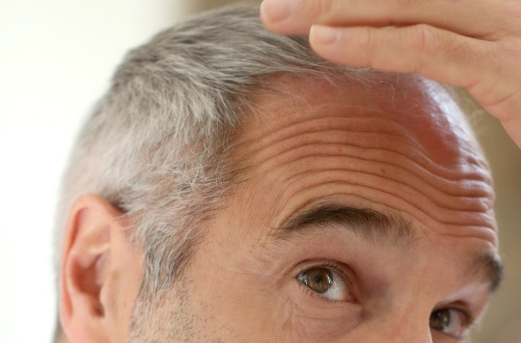 CLINIQUE CAPILLAIRE PRP | 1280 Rue King E #300, Sherbrooke, QC J1G 1E4, Canada | Phone: (819) 742-0777