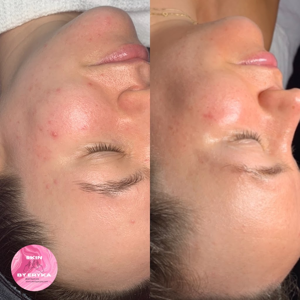Clinique Skin by Eryka | 9 Avenue de la Baie-de-la, Av. de la Baie de Valois suite 3, Pointe-Claire, QC H9S 5H2, Canada | Phone: (514) 577-0605