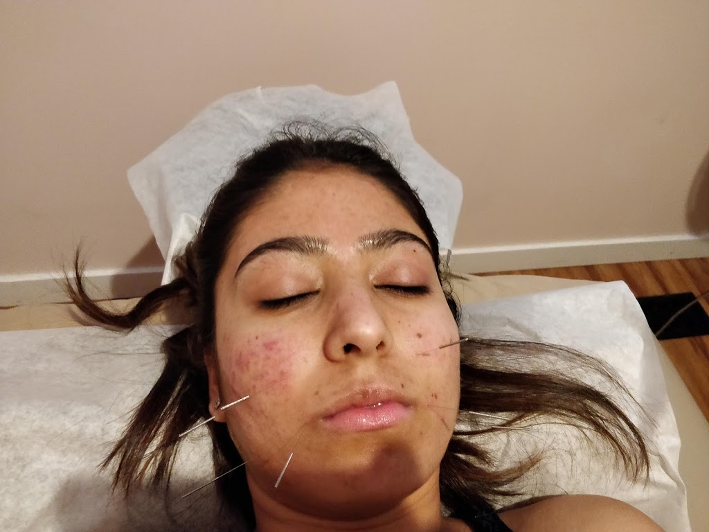 Acupuncture in Hamptons | 10109 Hamptons Blvd NW, Calgary, AB T3A 5A8, Canada | Phone: (403) 993-3202