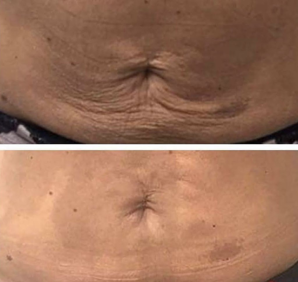 Plasma Skin Regeneration | 00 Ranch Gate, Strathmore, AB T1P 0B4, Canada | Phone: (403) 901-4663