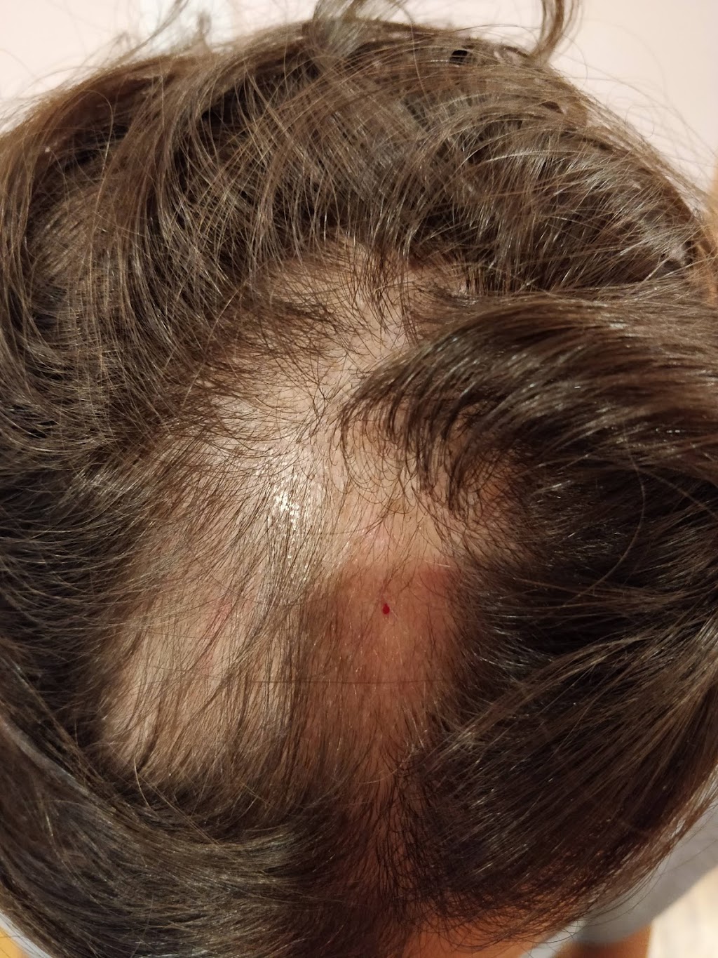 Acupuncture in Hamptons | 10109 Hamptons Blvd NW, Calgary, AB T3A 5A8, Canada | Phone: (403) 993-3202