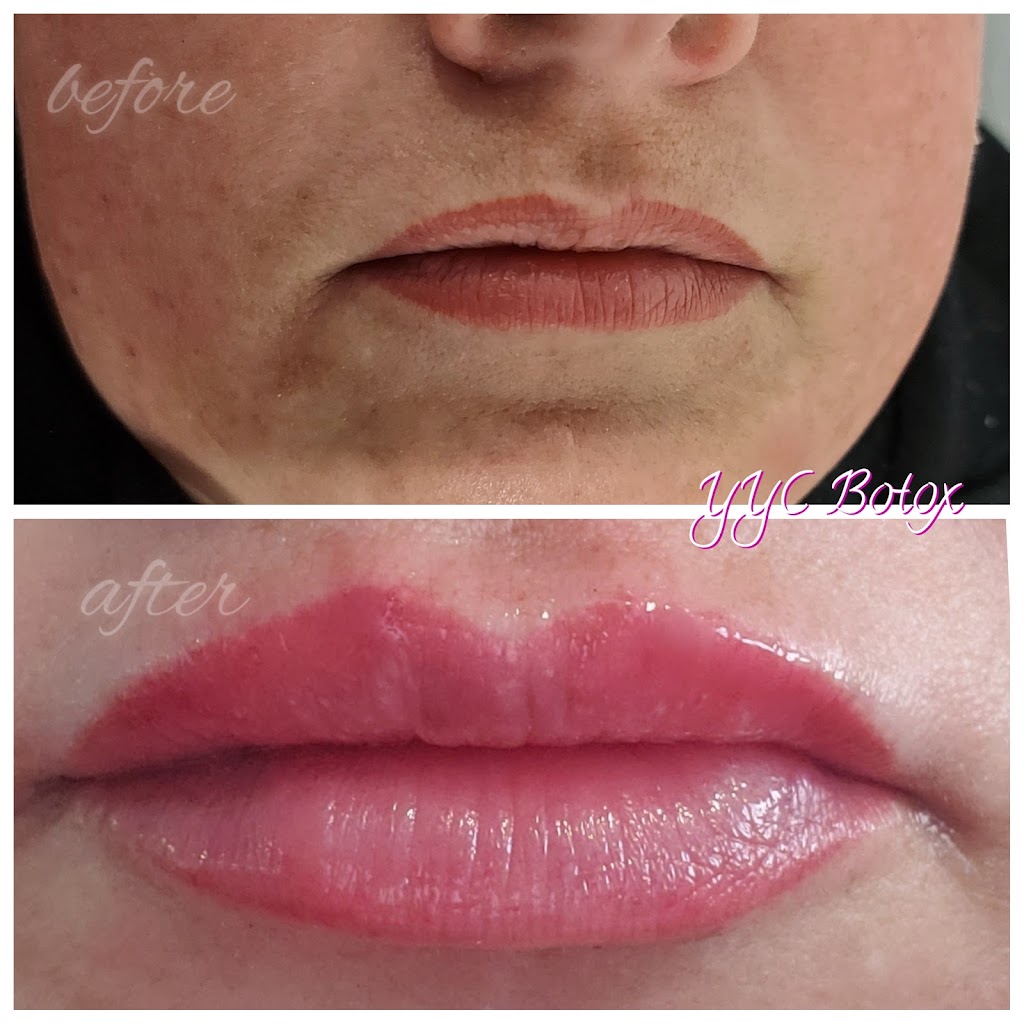 YYC Botox | 1715 10 Ave SW Second floor Unit 205, Calgary, AB T3C 0K1, Canada | Phone: (403) 460-7766