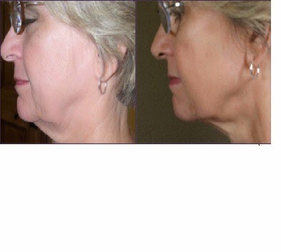 Clinique Médico-Esthétique In Situ | 131 Chemin Ozias-Leduc, Mont-Saint-Hilaire, QC J3H 3W6, Canada | Phone: (450) 714-1008