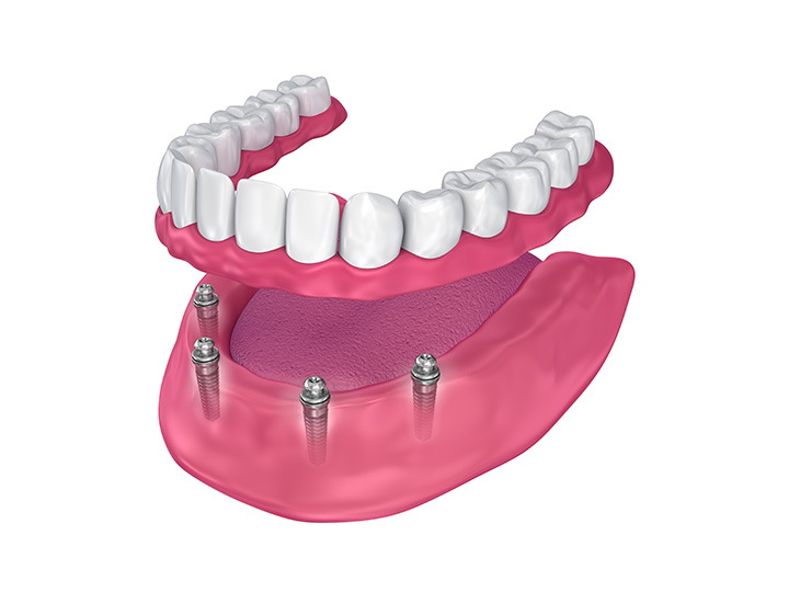 Annie Leclerc d.d. Denturologiste | 3020 Boulevard Rome Local 8, Brossard, QC J4Y 2M7, Canada | Phone: (450) 656-1368