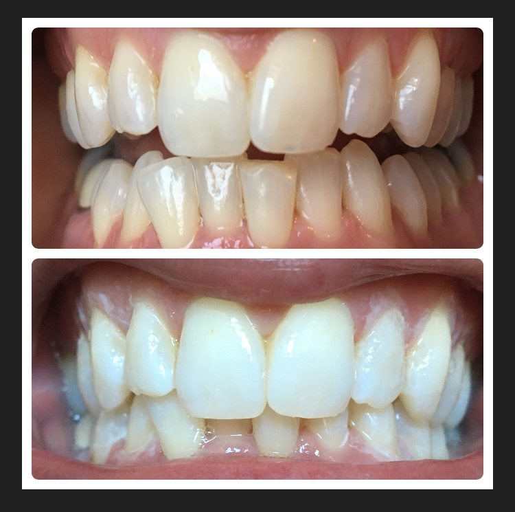 Dental Hygiene on Demand | 7 Fairwood Dr, Keswick, ON L4P 3S2, Canada | Phone: (289) 383-1688
