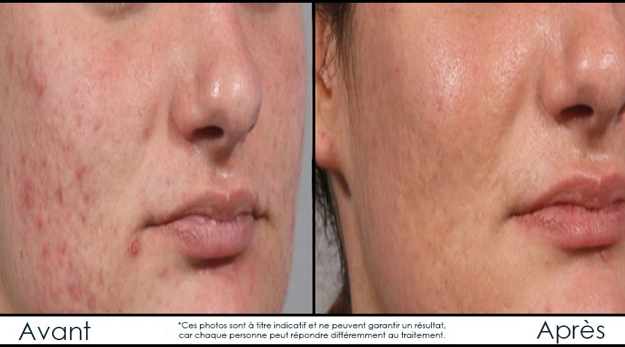 Infinium Médecine Esthétique | 729 Boulevard Saint-Joseph, Gatineau, QC J8Y 4B6, Canada | Phone: (819) 771-4284