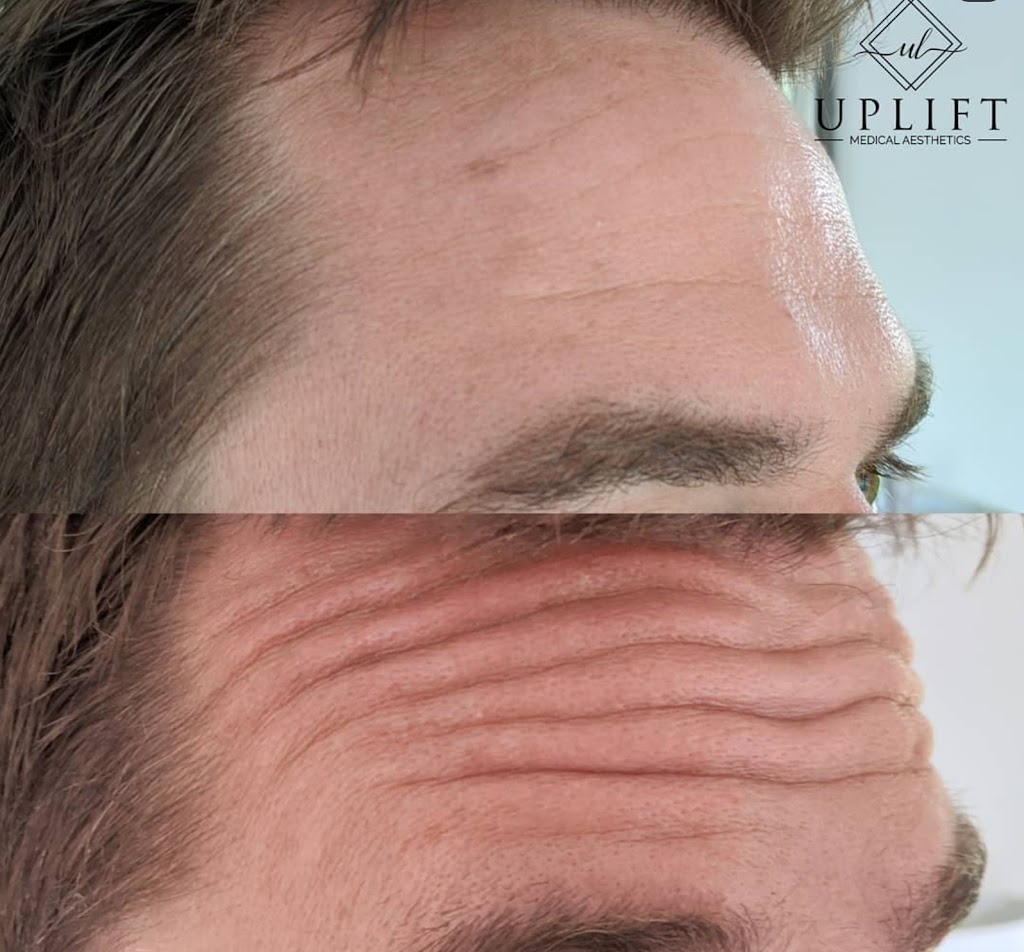 Uplift Medical Aesthetics | 2022 Main St N, Jarvis, ON N0A 1J0, Canada | Phone: (519) 420-9225