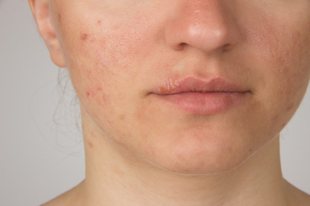 Acne Treatment Ottawa | 3320 McCarthy Rd #2006, Ottawa, ON K1V 0X3, Canada | Phone: (613) 714-0770