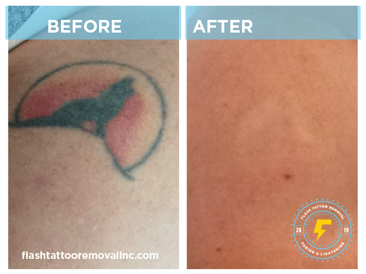 FLASH Tattoo Removal Calgary | 1530 9 Ave SE, Calgary, AB T2G 0T7, Canada | Phone: (403) 978-5488