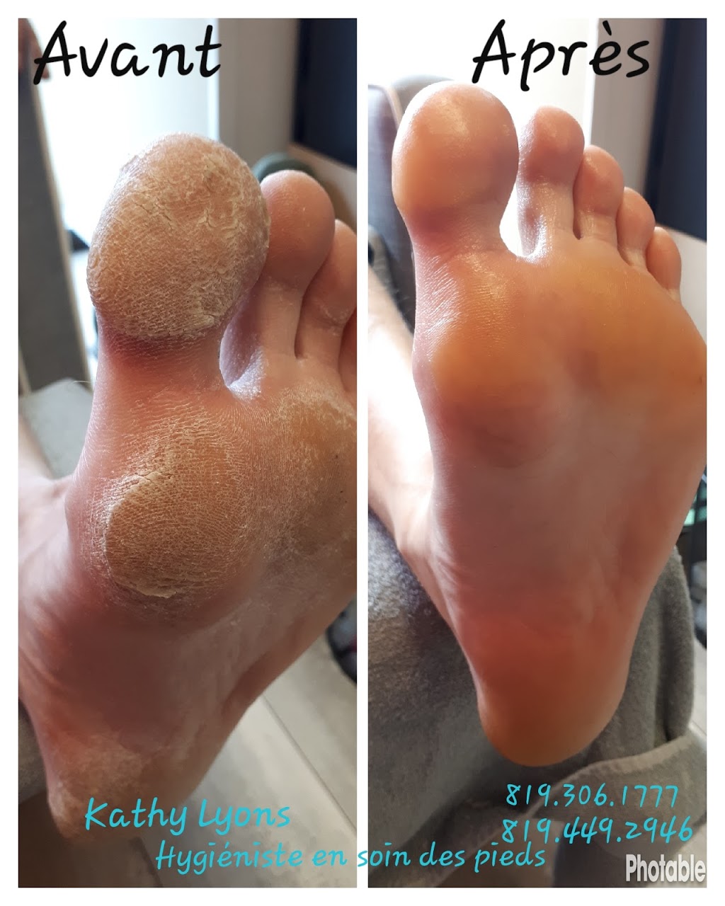 Kathy Lyons Hygiéniste en Soins des pieds à domicile | 110 Ch Farley, Messines, QC J0X 2J0, Canada | Phone: (819) 449-2946