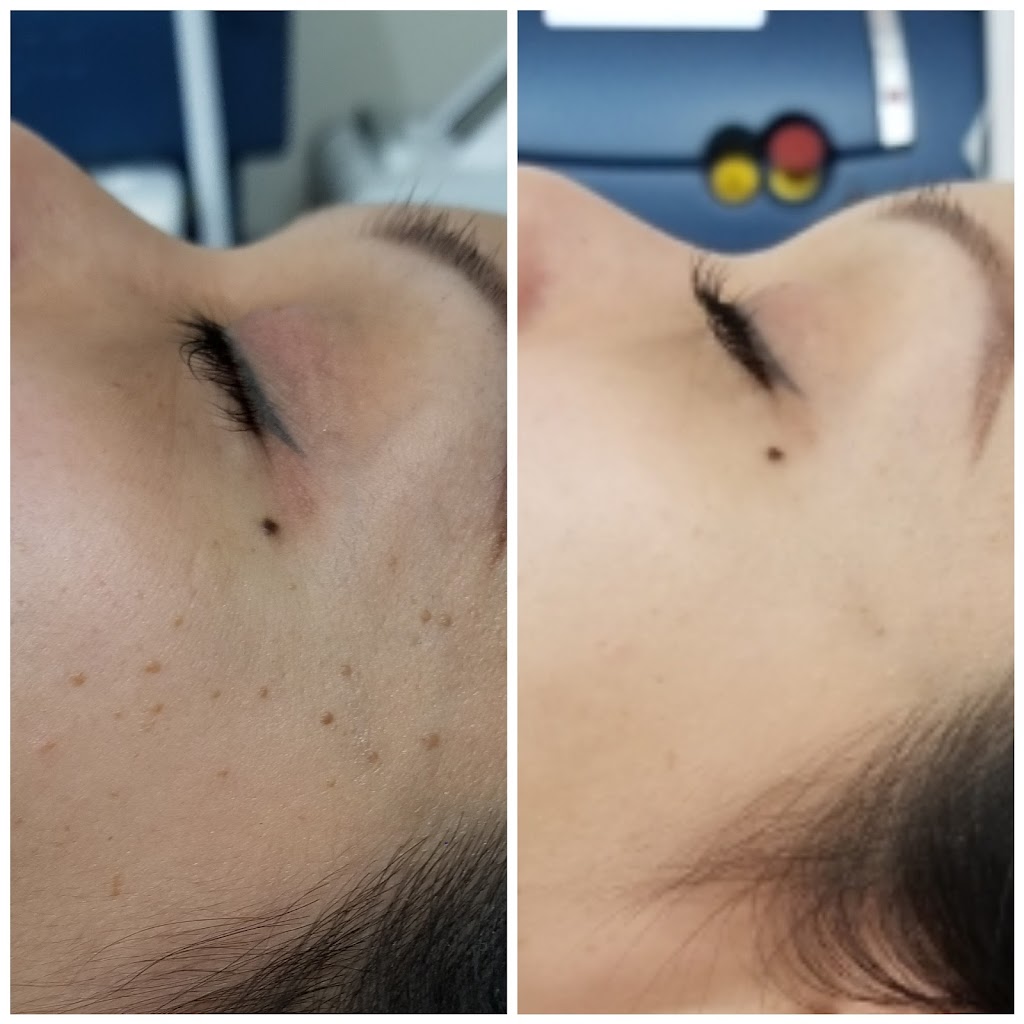 Skin Essentials Laser Clinic | 58 Cathedral High St, Markham, ON L6C 0P3, Canada | Phone: (416) 843-7458