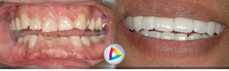 Compleo at Dentistry At Vitality Health | East, 4792 Hwy 7, Unionville, ON L3R 1M8, Canada | Phone: (647) 993-4792