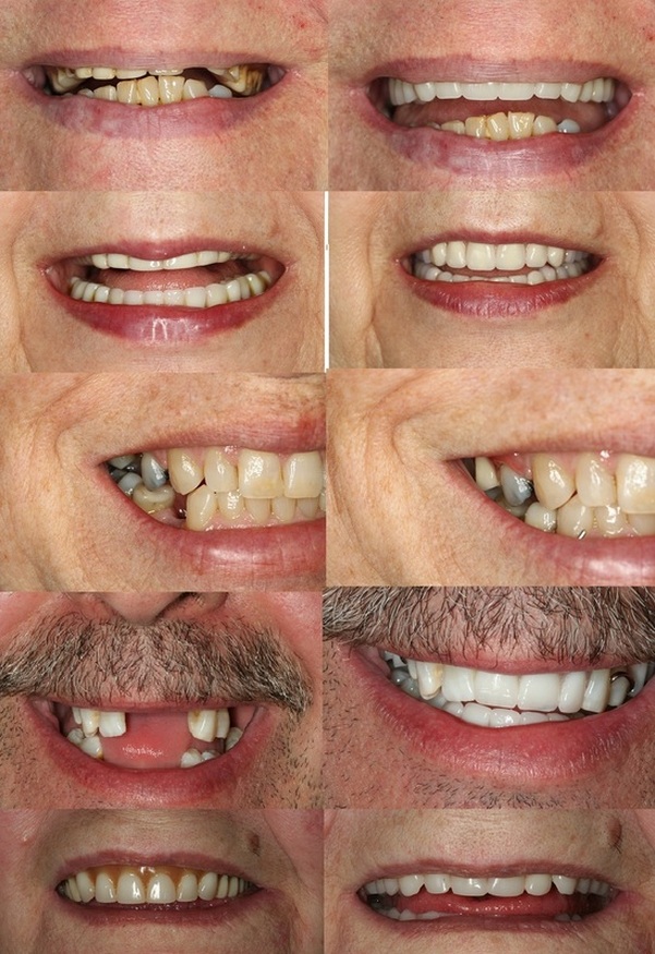 Mobile Dentures - Denture Clinic | 574 Rapids Ln, Mississauga, ON L5G 0A9, Canada | Phone: (416) 939-0292