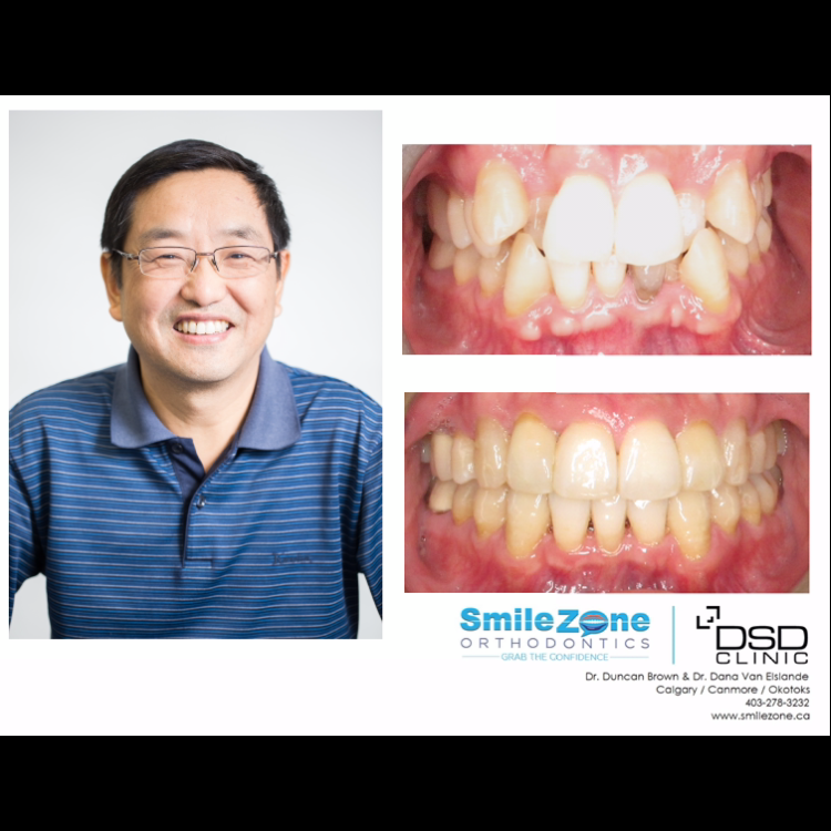 SmileZone Orthodontics | 31 Southridge Dr #151, Okotoks, AB T1S 1V3, Canada | Phone: (587) 757-9440