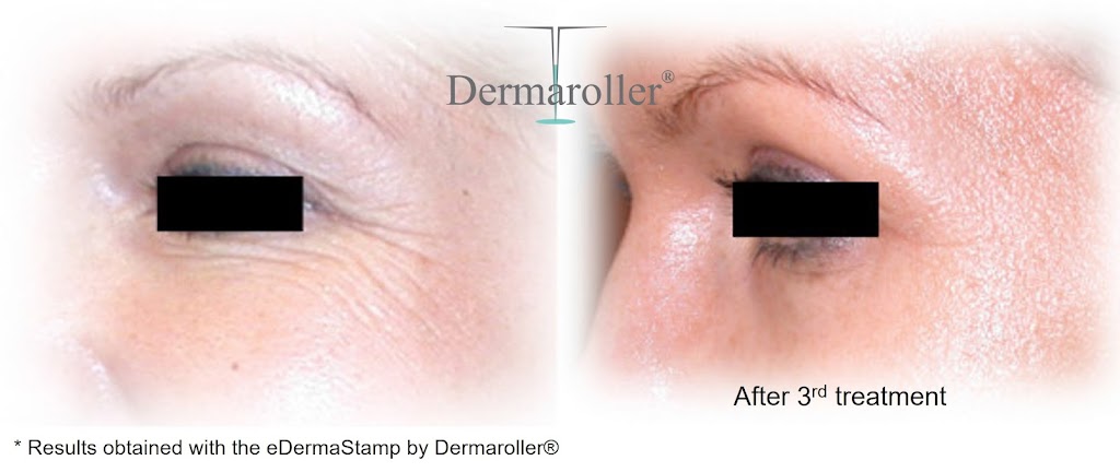 Esthétique Euro laser - Soin du visage Saint Laurent | 3500 Boulevard Cote Vertu Ouest Suite 130, Saint-Laurent, QC H4R 1P8, Canada | Phone: (514) 823-5292