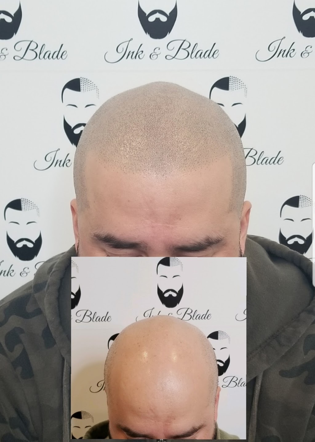 Ink and Blade - Micropigmentation Capillaire | 87 Boulevard Saint-Elzéar O, Laval, QC H7M 1E7, Canada | Phone: (438) 879-2417
