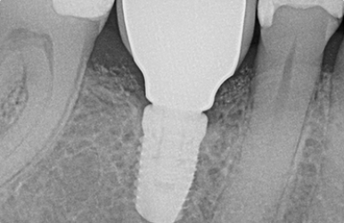 Smile Dental Implant Center - White Rock Dentists & Dental Implants | 1959 152 St, Surrey, BC V4A 9E3, Canada | Phone: (604) 531-3344