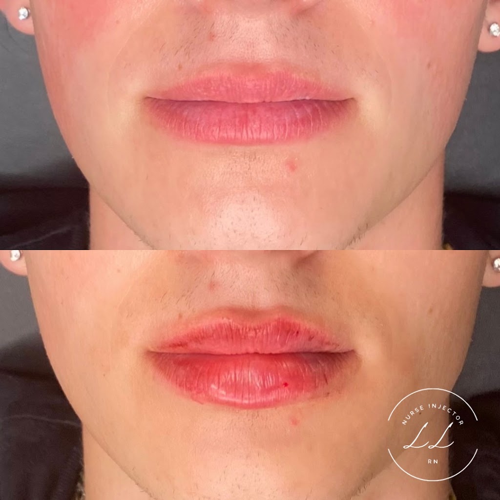 Lauren Landry RN - Halifax Injector: Botox and Dermal Fillers | 6461 Quinpool Rd, Halifax, NS B3L 1B1, Canada | Phone: (902) 789-1174