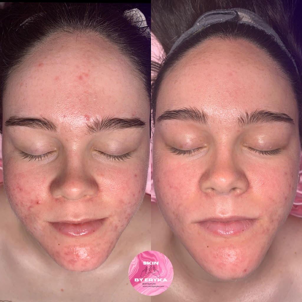 Clinique Skin by Eryka | 9 Avenue de la Baie-de-la, Av. de la Baie de Valois suite 3, Pointe-Claire, QC H9S 5H2, Canada | Phone: (514) 577-0605