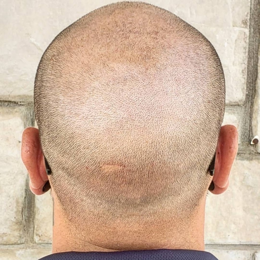 Scalp Micropigmentation by Chronic Ink - Markham | 7381 Kennedy Rd Unit #105, Markham, ON L3R 5B5, Canada | Phone: (905) 305-0311
