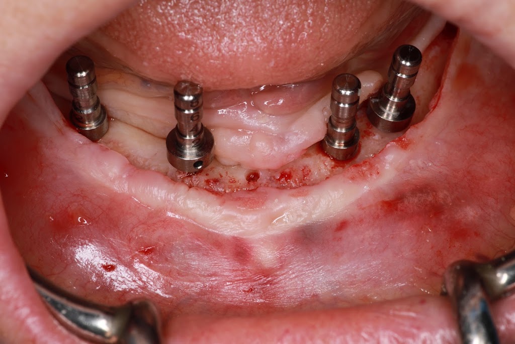Kasper Denture clinic ltd | 1710 Ellis St Suite 25, Kelowna, BC V1W 3S9, Canada | Phone: (250) 717-3730