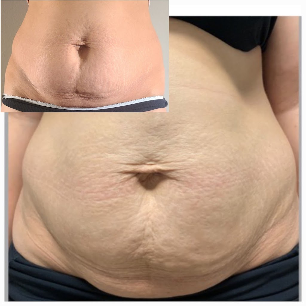 SUES PURE LASER | 75 Templebow Way NE, Calgary, AB T1Y 5B5, Canada | Phone: (587) 439-2776