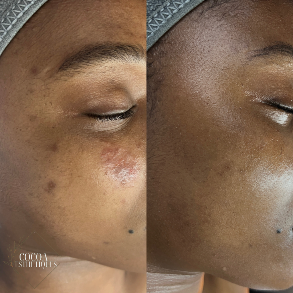 Cocoa Esthetiques | 350 (3rd Floor, 2414 16 Ave NW Suite 24, Calgary, AB T2M 0M5, Canada | Phone: (587) 883-9943