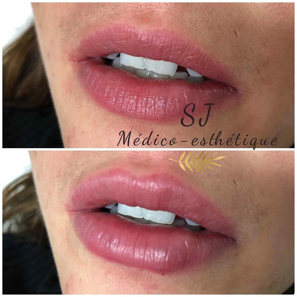 Médico-esthétique SJ | 30 Rue Émile-Despins #2A, Charlemagne, QC J5Z 3S8, Canada | Phone: (450) 585-1990
