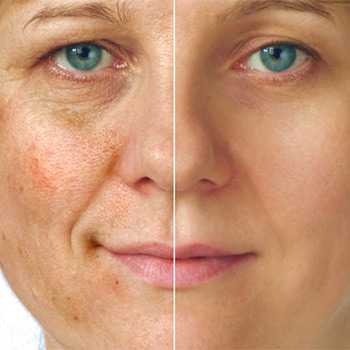 Skin Care Lazer YXE | Sunsera Salon. Ask for Olga (Laser technician, 815 Gray Ave, Saskatoon, SK S7N 2K6, Canada | Phone: (639) 318-9969