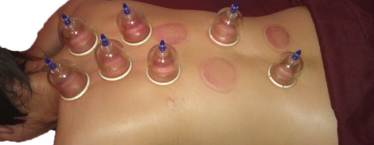Medical Cupping and Therapeutic Clinic | 2318 Russell Rd, Ottawa, ON K1G 1B4, Canada | Phone: (613) 600-9667