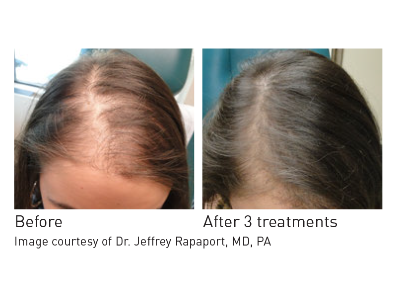 Aurora Hair Loss Clinic | 372 Hollandview Trail unit 302, Aurora, ON L4G 0A5, Canada | Phone: (905) 503-4001