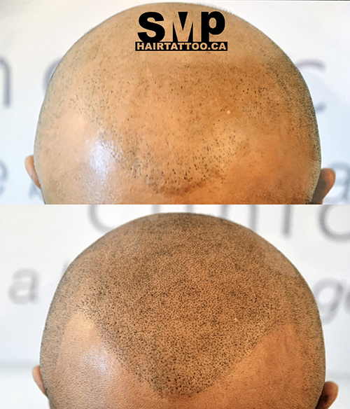 SMP® Scalp Micropigmentation Richmond Hill | HAIRTATTOO.CA | 9140 Leslie St #301, Richmond Hill, ON L4B 3L6, Canada | Phone: (647) 492-9093