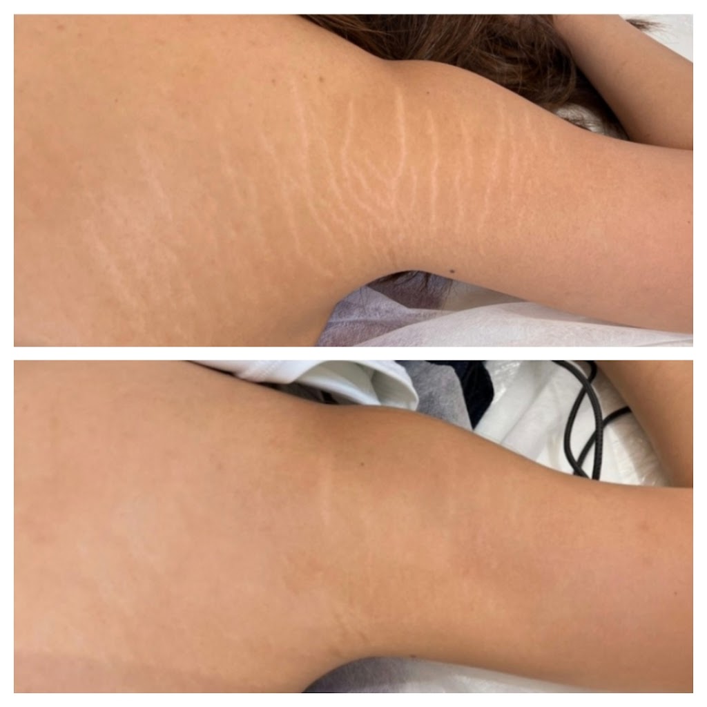 Efface Skin Care Clinic Inc. | 72 King St W, Stoney Creek, ON L8G 1H8, Canada | Phone: (905) 745-4097