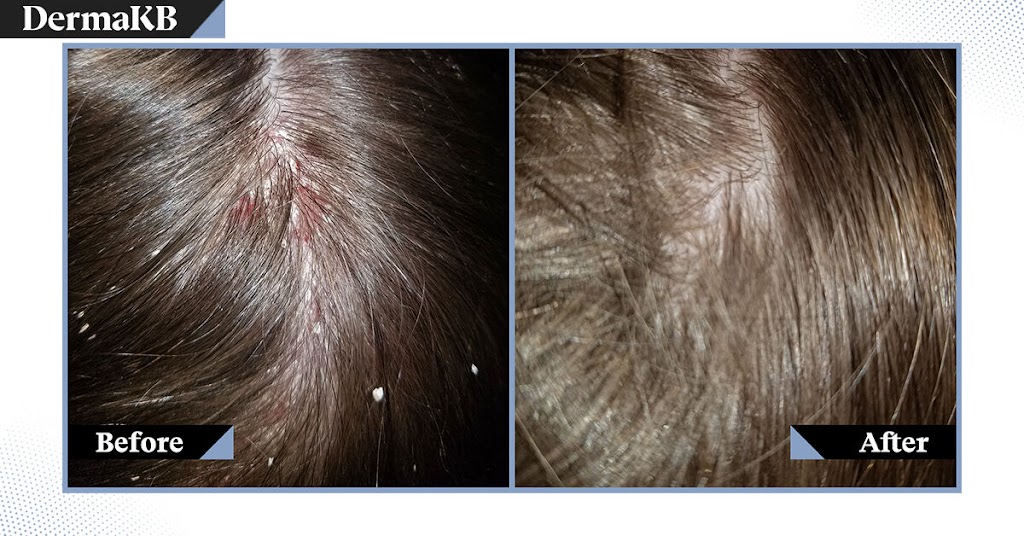 DermaKB Biofilm - Shampoo, Scalp Detoxifier | 100 Innovation Dr #290, Winnipeg, MB R3T 6G2, Canada | Phone: (855) 682-1560