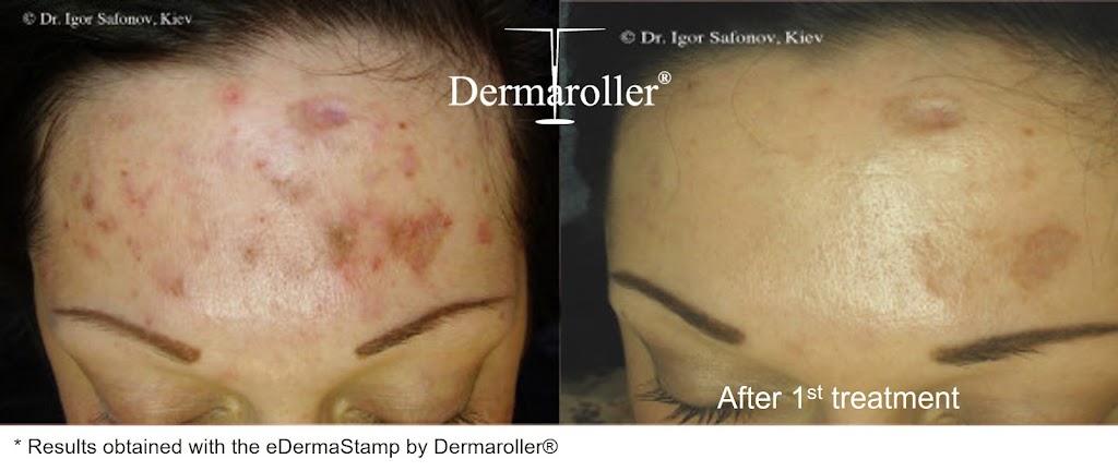 Esthétique Euro laser - Soin du visage Saint Laurent | 3500 Boulevard Cote Vertu Ouest Suite 130, Saint-Laurent, QC H4R 1P8, Canada | Phone: (514) 823-5292