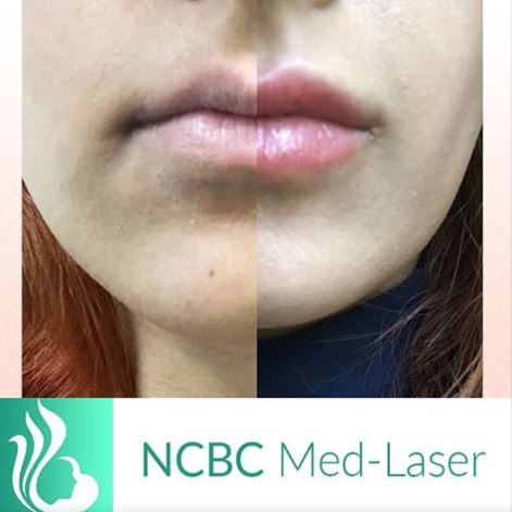 NCBC Med-laser | 5179 Yonge St #208, North York, ON M2N 5P5, Canada | Phone: (416) 222-8188